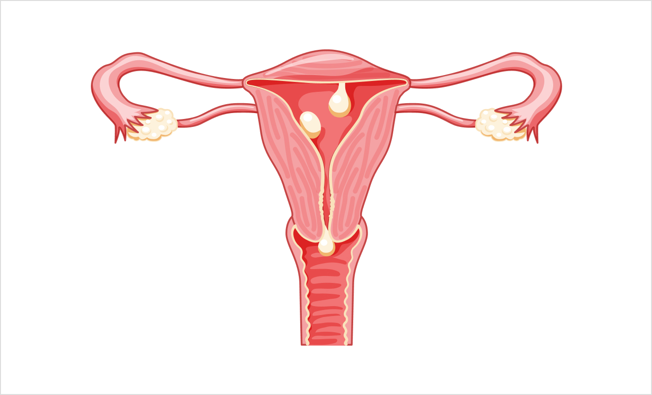 자궁내막용종, 점막하 자궁근종